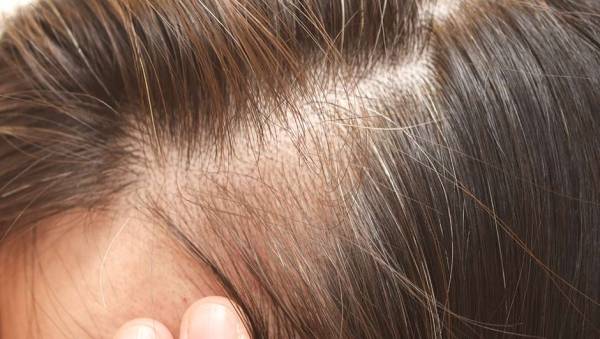 درمان های ریزش موی ارثی
