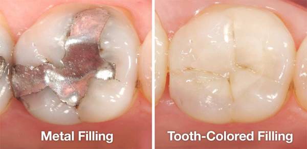 روش های پرکردن دندان