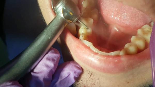 درد پس از پر کردن دندان
