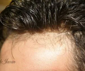 ترمیم مو