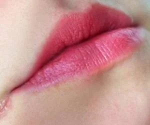 ترک گوشه لب