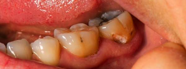 دلیل پوسیدگی دندان