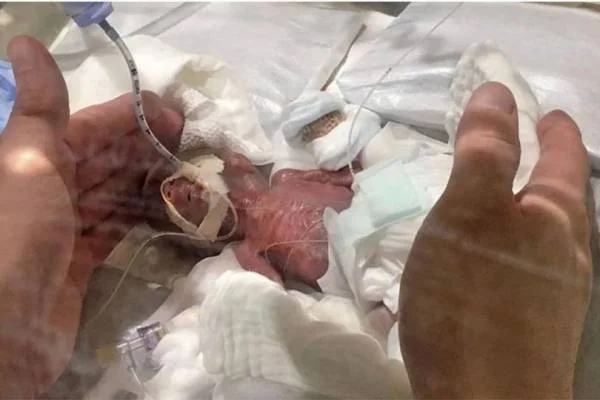نوزادی با 268 گرم وزن 