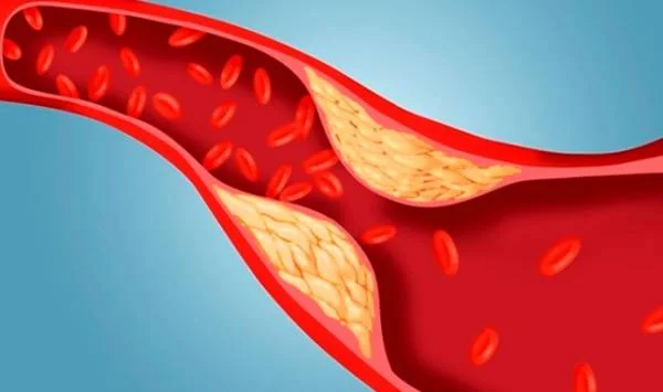 درمان اختلالات لیپیدی 