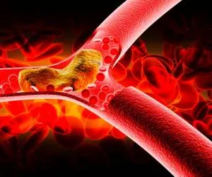 تری گلیسرید