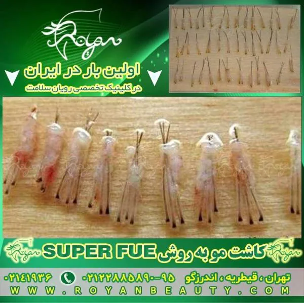 پیوند مو