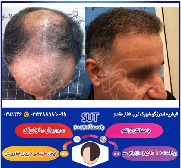 کاشت مو