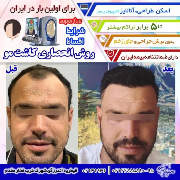 کاشت ریش و سبیل
