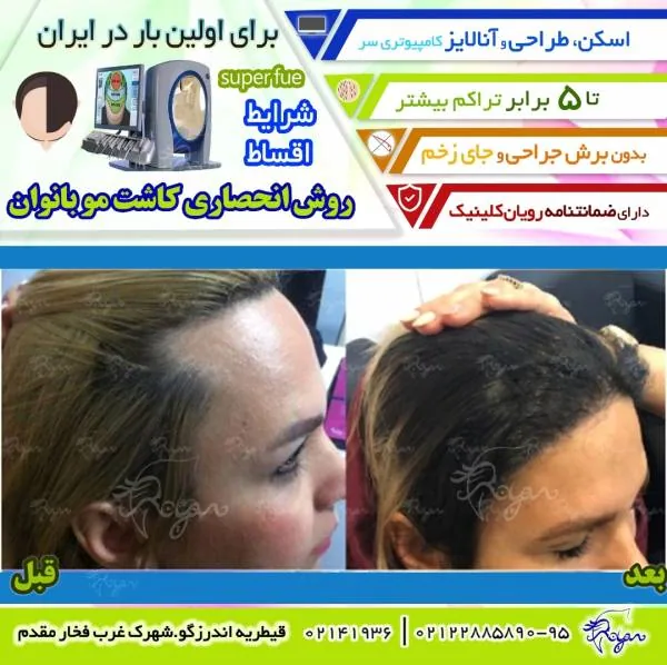 کاشت مو