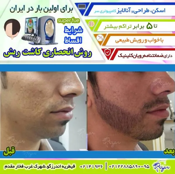 کاشت مو