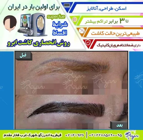 کاشت مو