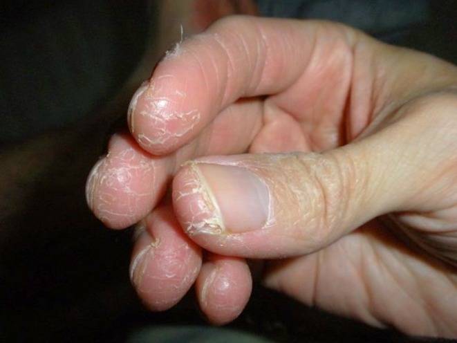اگزما و خارش پوست