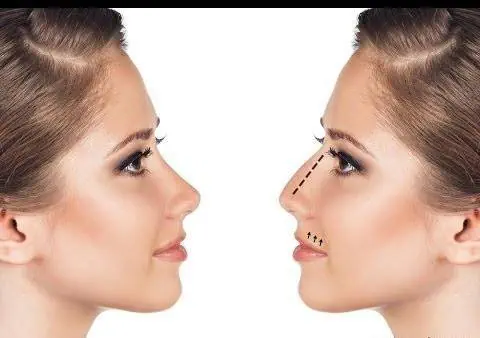 بینی زیبا بدون جراحی
