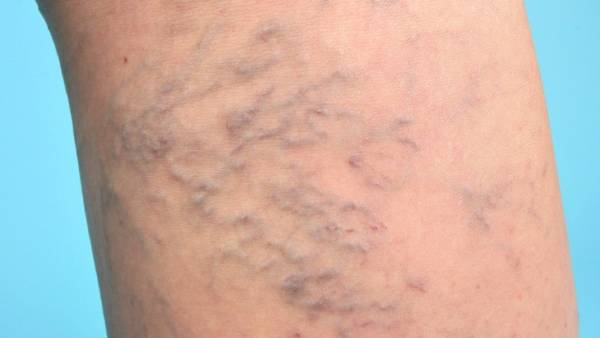 عوارض واریس چیست