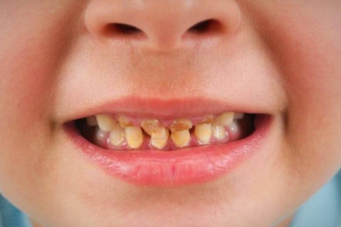 درمان تغییر رنگ دندان