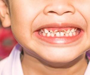 تغییر رنگ دندان کودکان