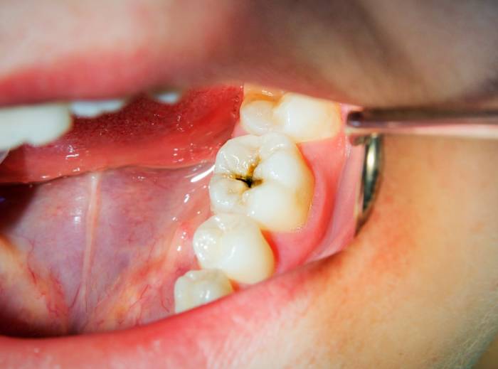 احتمال پوسیدگی دندان
