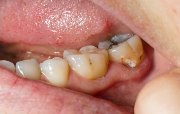 دلیل پوسیدگی دندان