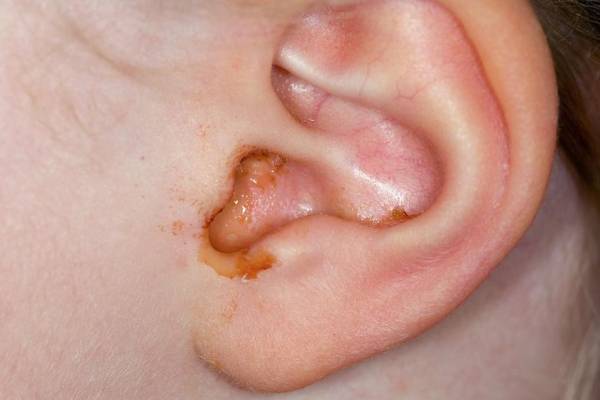اسرار سلامتی داخل گوش از جرم گوش جرم گوش