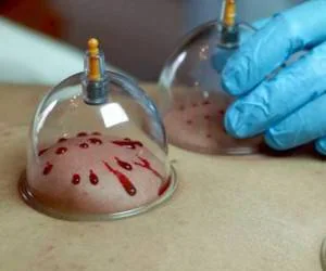 نیاز به حجامت