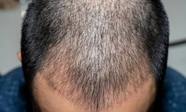 نشانه های عفونت بعد از کاشت مو