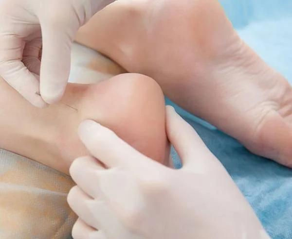 طب سوزنی