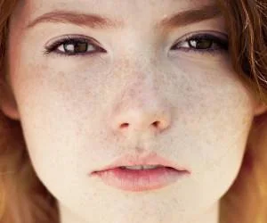 لکه های قهوه ای پوست