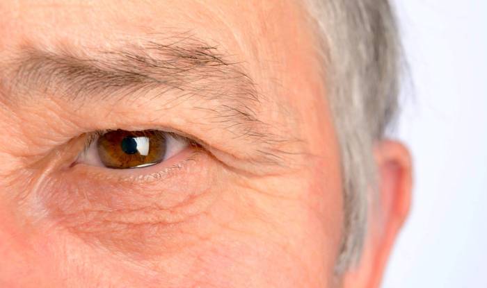 افتادگی پلک