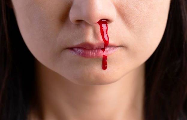 خونریزی بینی