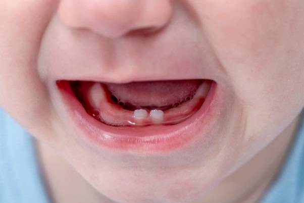 رشد دندان نوزاد