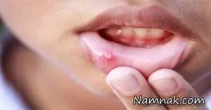 زخم های دهان