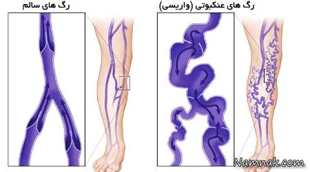 رگهای عنکبوتی