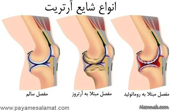 آرتریت روماتوئید