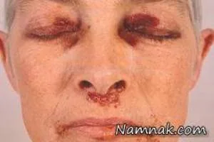 آمیلوئیدوز