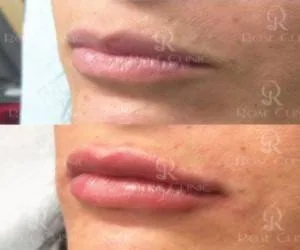 تزریق ژل