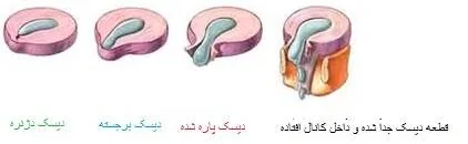 دیسک کمر