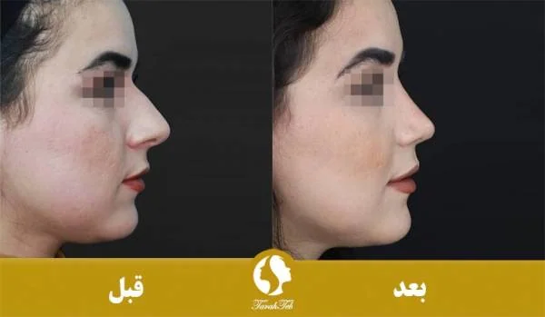 جراحی بینی