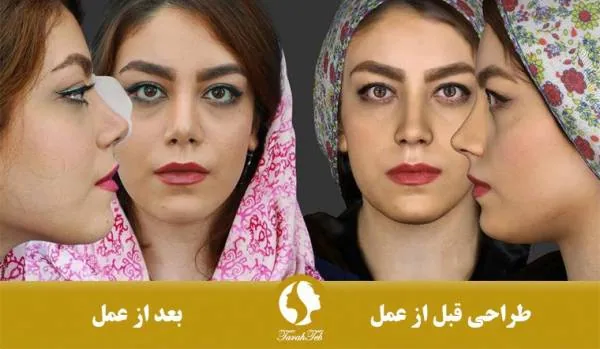 عمل بینی