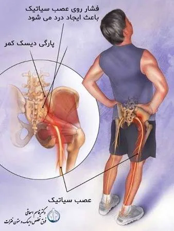 درد عصب سیاتیک