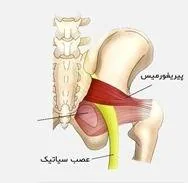 تشخیص درد سیاتیک