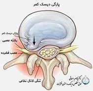 تشخیص درد سیاتیک