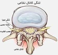 تشخیص درد سیاتیک