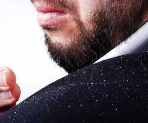 Dandruff