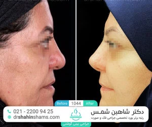 rhinoplasty