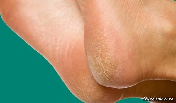 تغییر ظاهر پا با این بیماری ها