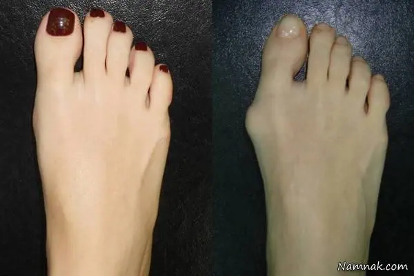  هالوکس والگوس درمان