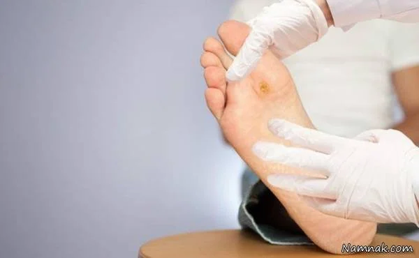 زخم پای دیابتی طب سنتی