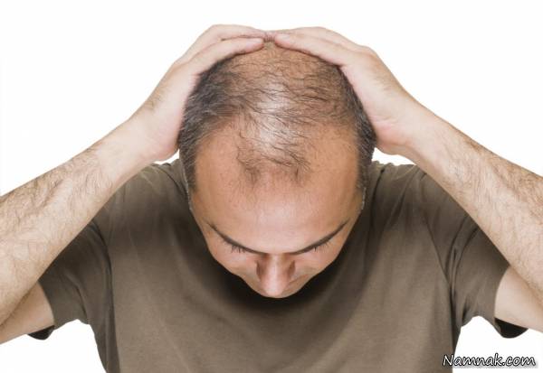 درمان ریزش مو مردان 