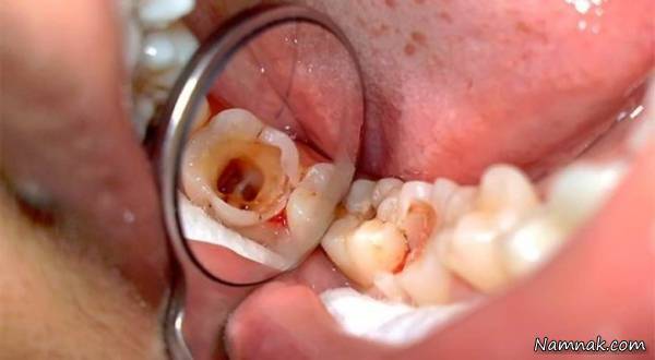 علت عصب کشی دندان