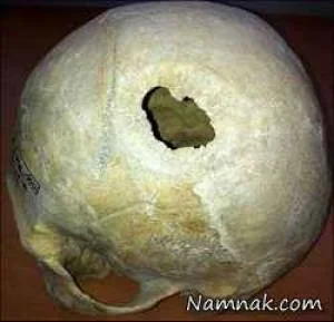 جراحی مغز